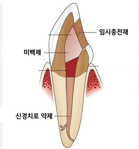 [치아미백] 예전에 부딪힌 앞니가 까맣게 변했어요. 신경이 죽은 치아를 하얗게 돌려놓기! (서울재생치과) 관련 이미지 7