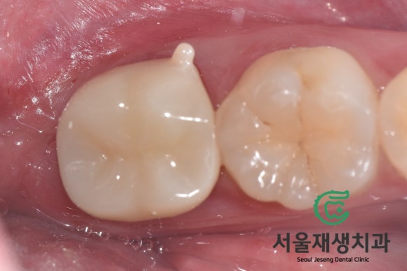 [고난이도 신경치료] 사랑니 때문에 뿌리가 흡수되어 버린 치아...살릴 수 있나요? 관련 이미지 9