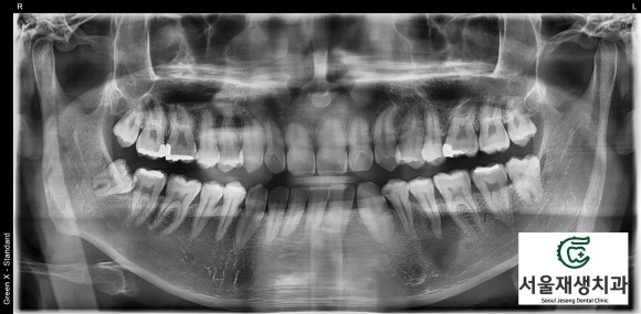 [치외치신경치료] 뿌리 끝 염증이 커서 발치해야된대요! 치아 머리에 볼~록! 알고보면 무서운 작은 혹 (서울재생치과) 관련 이미지 10