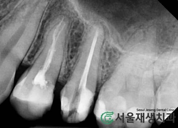 [재신경치료] 다른 치과에서 빼라고 했는데...혹시 살릴 수는 없을까요? (현미경 신경치료, 서울재생치과) 관련 이미지 4