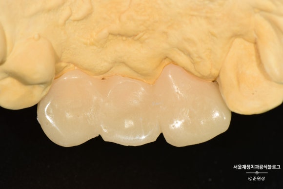 [치아외상] 부러진 앞니, 발치가 답인가요? (사고로 부러진 치아, 외과적정출술로 살리기) 관련 이미지 24