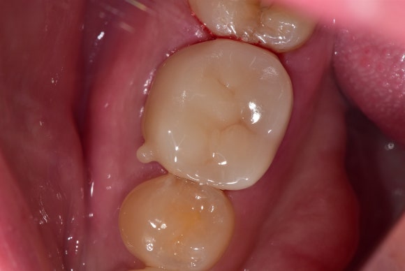 [재신경치료] 6개월 전에 신경치료한 치아에서 고름이 나와요. 관련 이미지 11