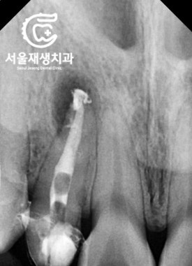 [재신경치료] 소중한 내 앞니...재신경치료로 다시 한 번 살려 쓸 수 있습니다. (서울재생치과, 현미경신경치료) 관련 이미지 8
