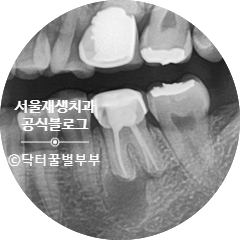 [재신경치료] 뿌리 끝 염증이 너무 심하대요...발치만이 답인가요? (폭발적인 반응에 부랴부랴 들고 온 두 번째 증례) 관련 이미지 3