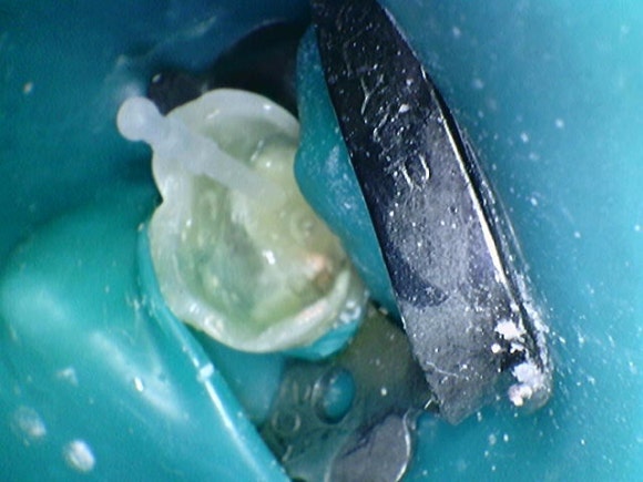 [신경치료] 충치가 커서 뿌리만 남았대요. 비발치 신경치료로 자연치아 살리기! 관련 이미지 6