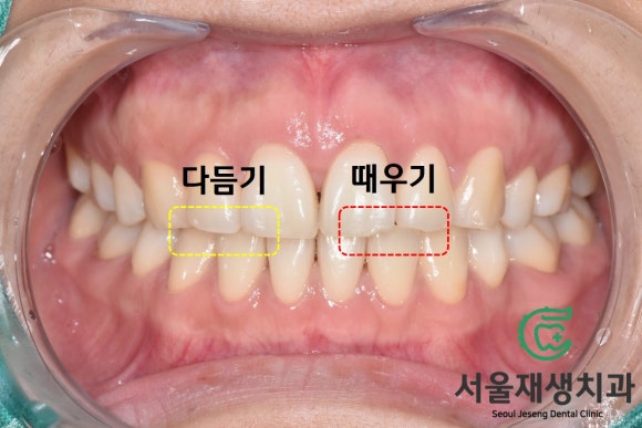 [깨진앞니치료] 살짝 다듬고, 살짝 때우고! (서울재생치과 신촌) 관련 이미지 4