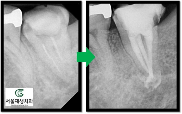 [재신경치료] 예전에 신경치료 받은 치아가 갑자기 너무 아파요! (서울재생치과, 현미경신경치료) 관련 이미지 8