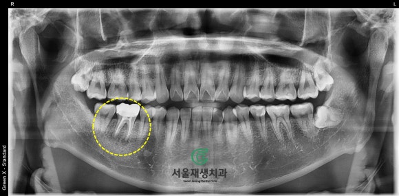 [재신경치료] 3년 전에 신경치료 했던 치아인데 다시 아파요! (미세 현미경 재신경치료, 서울재생치과) 관련 이미지 3
