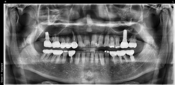 [임플란트] 재신경치료를 시도할 수 없을 때. 뼈이식 없는 임플란트 시술로 간편하게. 관련 이미지 3