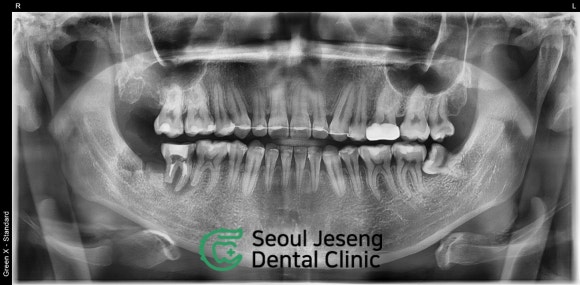 [고난이도 신경치료] 사랑니 때문에 뿌리가 흡수되어 버린 치아...살릴 수 있나요? 관련 이미지 4