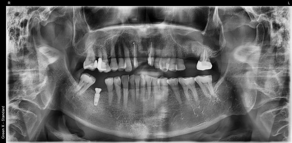 [임플란트] 이가 빠진지 오래되서 옆 치아들이 쓰러졌어요. 임플란트 가능할까요? 네, 가능합니다.1mm의 정교함으로! 관련 이미지 5
