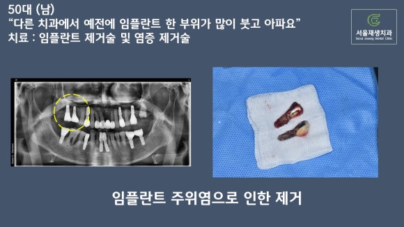 임플란트가 아플 때, 임플란트 잇몸이 부었을 때 어떻게 하나요? (임플란트 재수술, 서울재생치과, 신촌치과) 관련 이미지 8