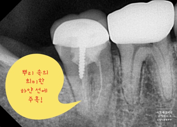 [재신경치료] 치아 뿌리 끝 염증이 너무 심하대요...발치만이 답일까요? 관련 이미지 5