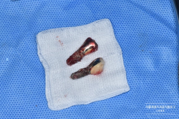 임플란트가 아플 때, 임플란트 잇몸이 부었을 때 어떻게 하나요? (임플란트 재수술, 서울재생치과, 신촌치과) 관련 이미지 7