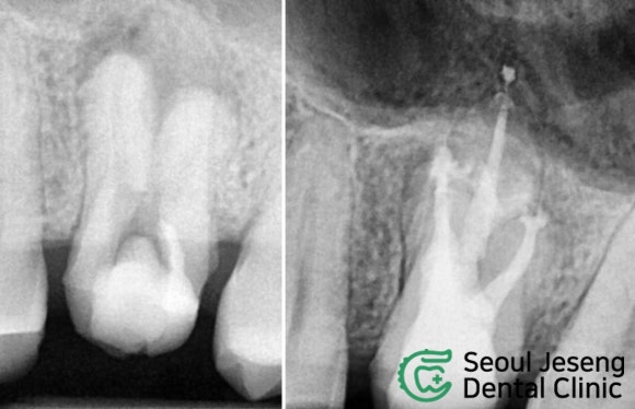 [재신경치료] 재신경치료까지 했는데 계속 아파요..미세 현미경을 이용한 세번째 신경치료! (서울재생치과) 관련 이미지 12