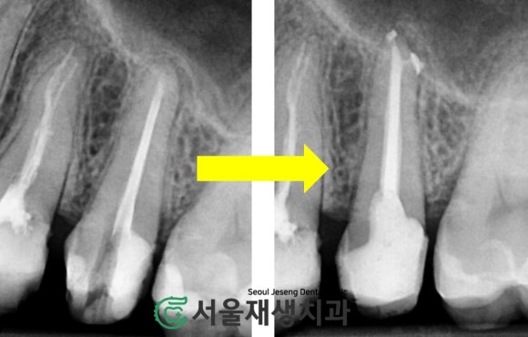 [재신경치료] 다른 치과에서 빼라고 했는데...혹시 살릴 수는 없을까요? (현미경 신경치료, 서울재생치과) 관련 이미지 10