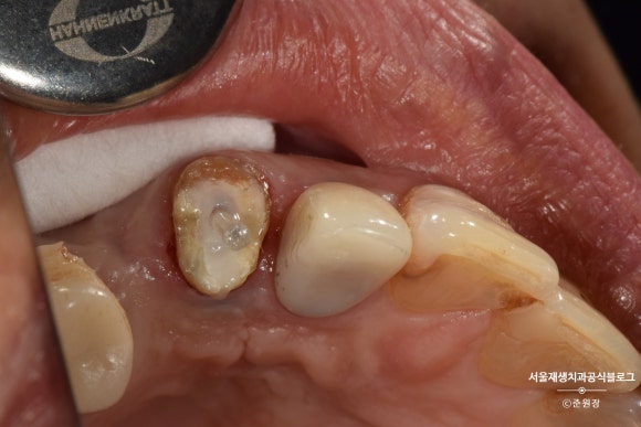 충치나 파절로 짧아진 치아도 다시 보자! (의도적 재식술/치아정출술 후 브릿지치료) 관련 이미지 12