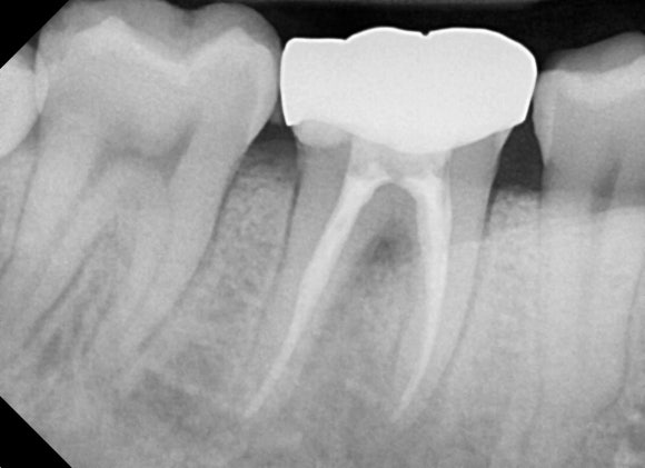 [재신경치료] 6개월 전에 신경치료한 치아에서 고름이 나와요. 관련 이미지 4