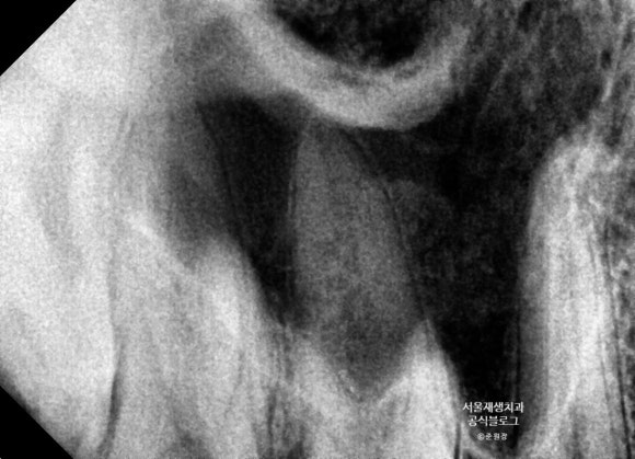 윗 어금니 신경치료 후에 코피가 나요 (신경치료 후 주의사항, 상악동, 신촌 서울재생치과, 신촌 신경치료 맛집, 현미경 신경치료) 관련 이미지 6