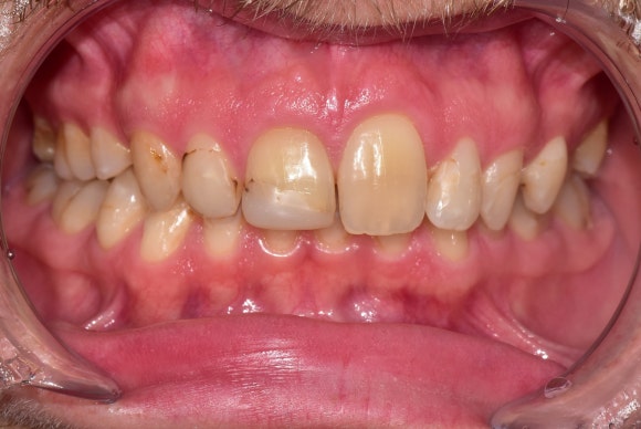 [앞니재치료] 얼룩덜룩한 오래된 레진, 새 이처럼 환하게 재치료하기 관련 이미지 3