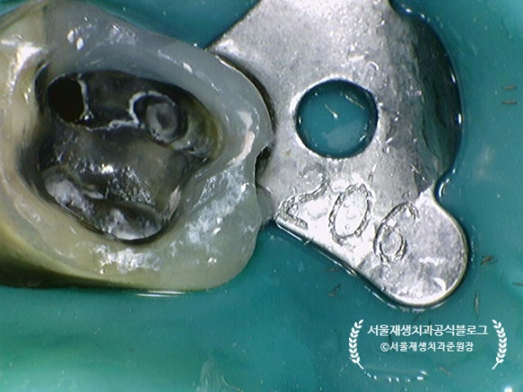 [재신경치료] 예전에 신경치료 받은 치아가 갑자기 붓고 아파요! (현미경을 통해 정확하고 섬세하게 재신경치료 하기) 관련 이미지 31