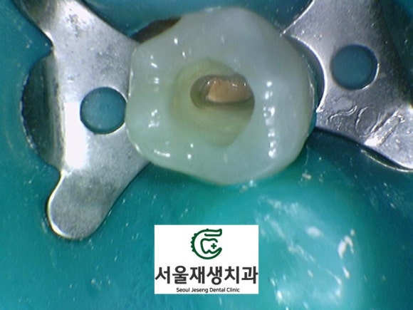 [치외치신경치료] 뿌리 끝 염증이 커서 발치해야된대요! 치아 머리에 볼~록! 알고보면 무서운 작은 혹 (서울재생치과) 관련 이미지 21