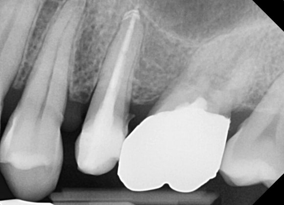 부러진 치아를 살려서 쓰는 법 (잇몸성형과 포스트식립) 관련 이미지 7