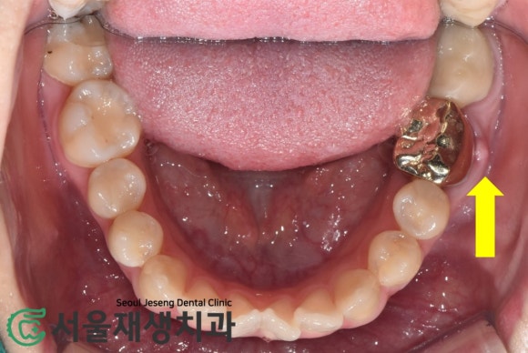 [재신경치료] 예전에 신경치료 받은 치아....치근단 절제술이나 발치를 해야 한다는데요?! (신촌 서울재생치과) 관련 이미지 7