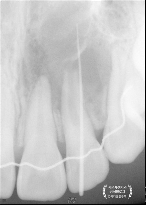 [재생근관치료] 이가 난지 얼마 안 됐는데 신경이 죽었대요...(소아 치아 외상, 치수 괴사, 미성숙 영구치, 신경재생술, REP, 치료기간, MTA 신경치료, 내원횟수) 관련 이미지 6