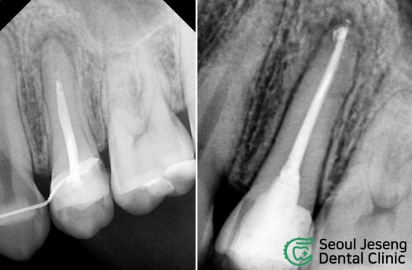 [치료사례] 재신경치료 (4) 관련 이미지 1