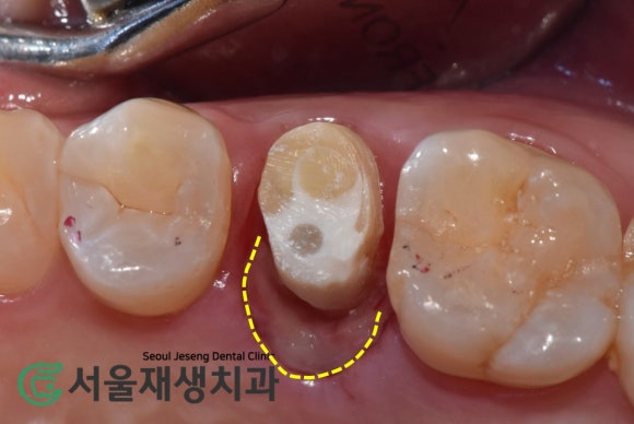 [치아파절] 밥 먹다가 이가 반으로 쪼개졌어요....이런 치아도 살릴 수 있나요? (깨진 치아 치료하기, 신촌 서울재생치과) 관련 이미지 8