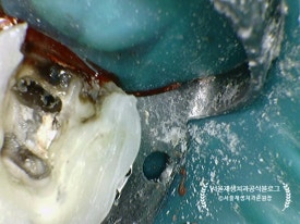 [재신경치료] 예전에 신경치료 받은 치아가 갑자기 붓고 아파요! (현미경을 통해 정확하고 섬세하게 재신경치료 하기) 관련 이미지 16