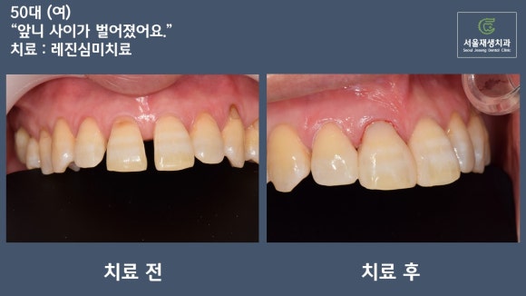 [치료사례] 벌어진 앞니 사이 공간...반드시 라미네이트와 크라운을 해야하나요? 레진으로 간단하고 예쁘게 성형하기 관련 이미지 5