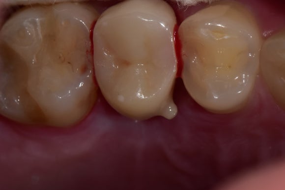 [치아살리기] 뿌리만 남은 치아의 치료 관련 이미지 8