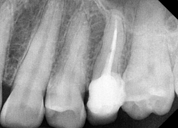 [치아살리기] 뿌리만 남은 치아의 치료 관련 이미지 7