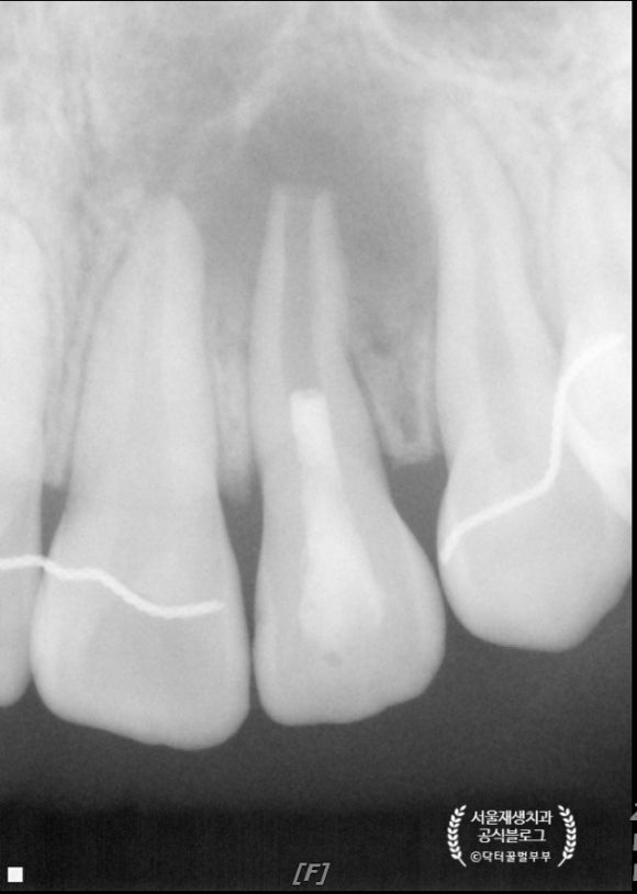 [재생근관치료] 이가 난지 얼마 안 됐는데 신경이 죽었대요...(소아 치아 외상, 치수 괴사, 미성숙 영구치, 신경재생술, REP, 치료기간, MTA 신경치료, 내원횟수) 관련 이미지 9