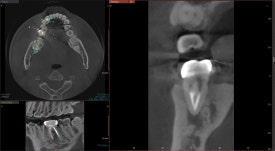 [재신경치료] 6개월 전에 신경치료한 치아에서 고름이 나와요. 관련 이미지 9