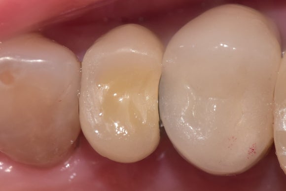 [임플란트] 좁은 공간에도 정밀하게, 1mm의 정교함을 잡은 임플란트 치료 관련 이미지 7