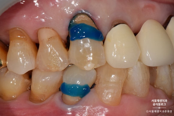 잇몸 패임, 무슨 재료로 때우나요? 레진과 글라스아이오노머(GI)로 치경부마모증 치료하기 (서울재생치과,신촌치과) 관련 이미지 15