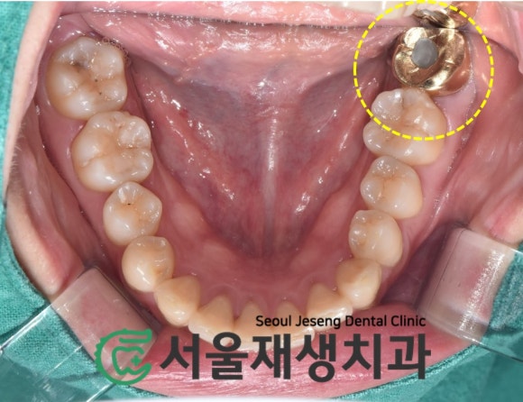 [재신경치료] 치과 종사자도 찾아오는 신경치료 전문치과, 서울재생치과! 관련 이미지 6