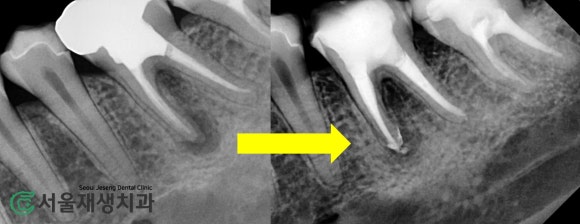 [재신경치료] 예전에 신경치료 받은 치아....치근단 절제술이나 발치를 해야 한다는데요?! (신촌 서울재생치과) 관련 이미지 13