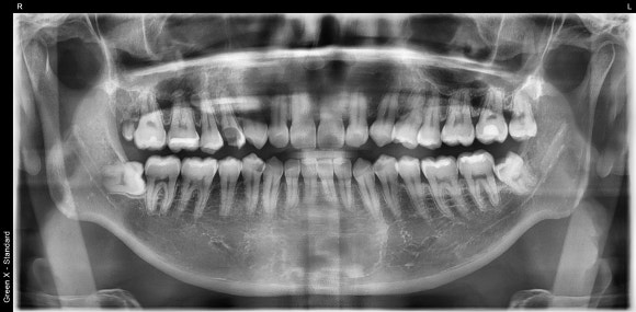 [신경치료] 충치가 커서 뿌리만 남았대요. 비발치 신경치료로 자연치아 살리기! 관련 이미지 3