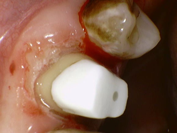 [치아살리기] 부러진 치아를 빼고 임플란트해야 한대요. 관련 이미지 7