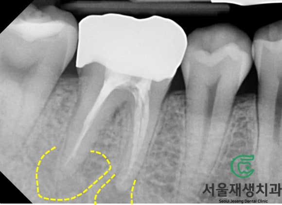 [재신경치료] 3년 전에 신경치료 했던 치아인데 다시 아파요! (미세 현미경 재신경치료, 서울재생치과) 관련 이미지 4