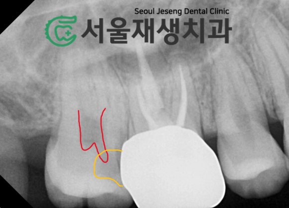 [MTA충치치료] 충치가 클 때.. 신경치료 안하고 치료하는 법 (치수복조술, 신촌 서울재생치과) 관련 이미지 6