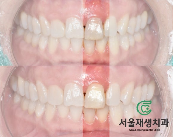 [치아미백] 예전에 다친 치아가 최근에 변색됐어요. 어떻게 해결하나요? (서울재생치과) 관련 이미지 10