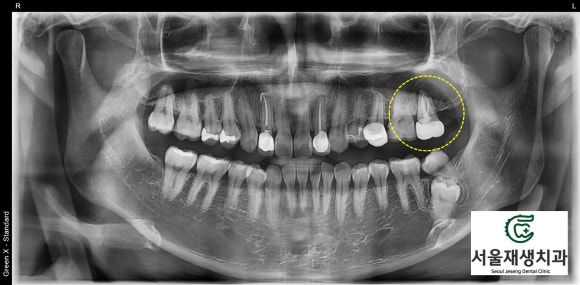 [재신경치료] 예전에 신경치료 한 치아가 갑자기 붓고 아파요! (현미경 신경치료, 서울재생치과) 관련 이미지 5