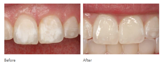 얼룩덜룩한 흰반점, white spot을 치료하는 법 (무삭제 충치치료) 관련 이미지 6