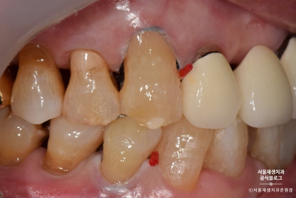 잇몸 패임, 무슨 재료로 때우나요? 레진과 글라스아이오노머(GI)로 치경부마모증 치료하기 (서울재생치과,신촌치과) 관련 이미지 17