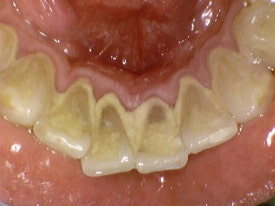 스케일링, 1년에 한 번만 보험이 되나요? 보험스케일링 수시로 받는 법 (건강보험적용 치과치료) 관련 이미지 2